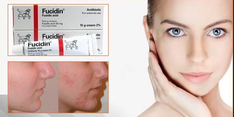 Fucidin Cream 20g Pimples 12pcs Dermatitis Acne Scars Wrinkles And Psoriasis Long Expiry 8602