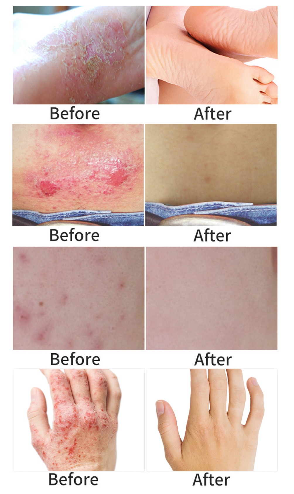 Yoxier Herbal Antibacterial Cream Psoriasis Cream Anti-itch Relief Eczema Skin Rash Urticaria Desquamation Treatment 20G