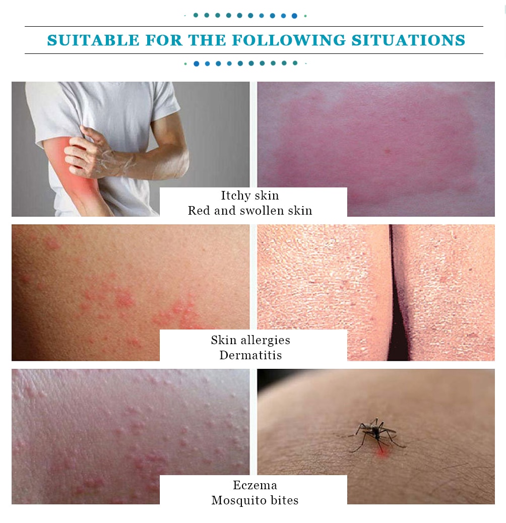 Yoxier Herbal Antibacterial Cream Psoriasis Cream Anti-itch Relief Eczema Skin Rash Urticaria Desquamation Treatment 20G